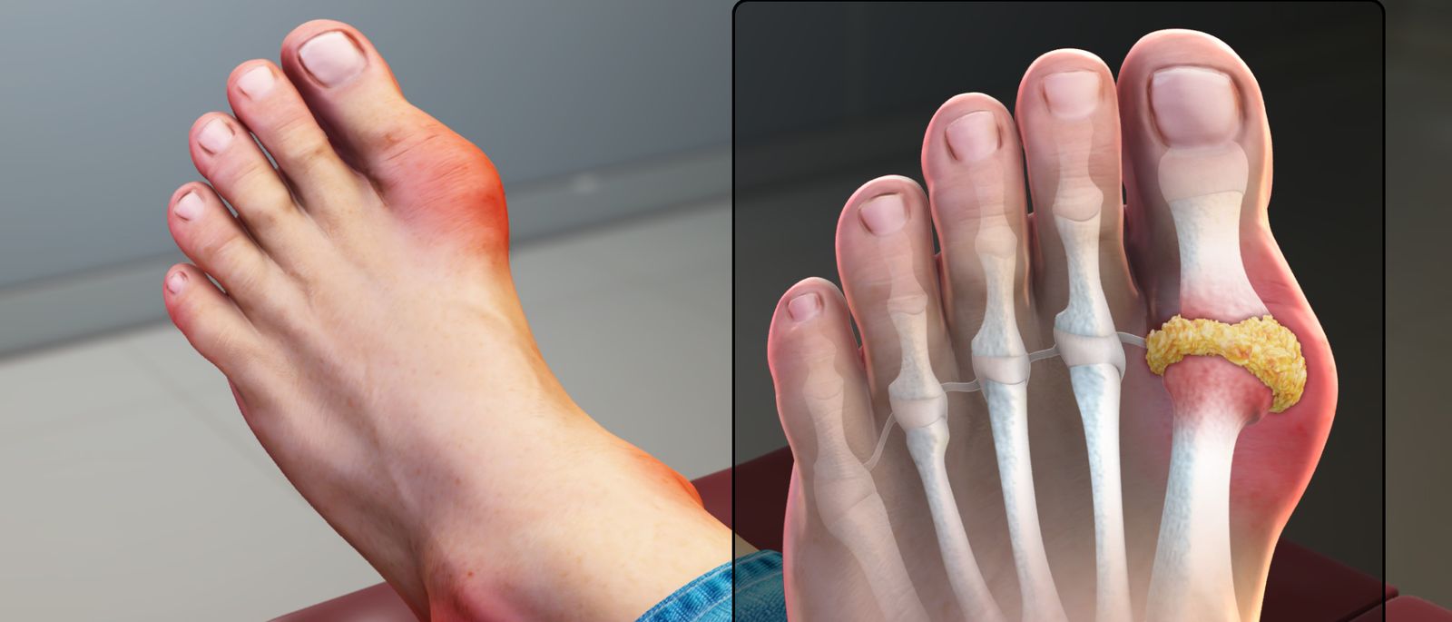 Infografis tanda dan gejala asam urat (gout)