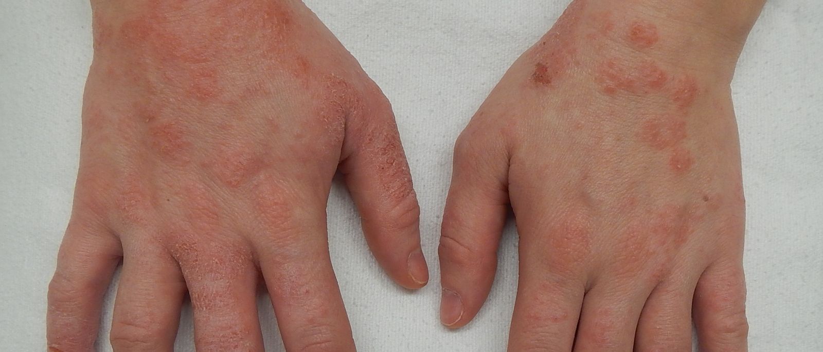 Foto medis kondisi kulit dermatitis untuk keperluan edukasi kesehatan