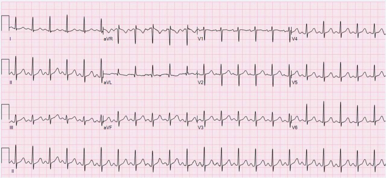 Rekaman EKG yang menunjukkan takikardia sinus atau detak jantung cepat, salah satu gejala utama hipertiroid